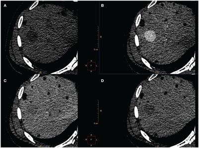 Case report: Liver PEComa after kidney transplantation in recipient with tuberous sclerosis complex